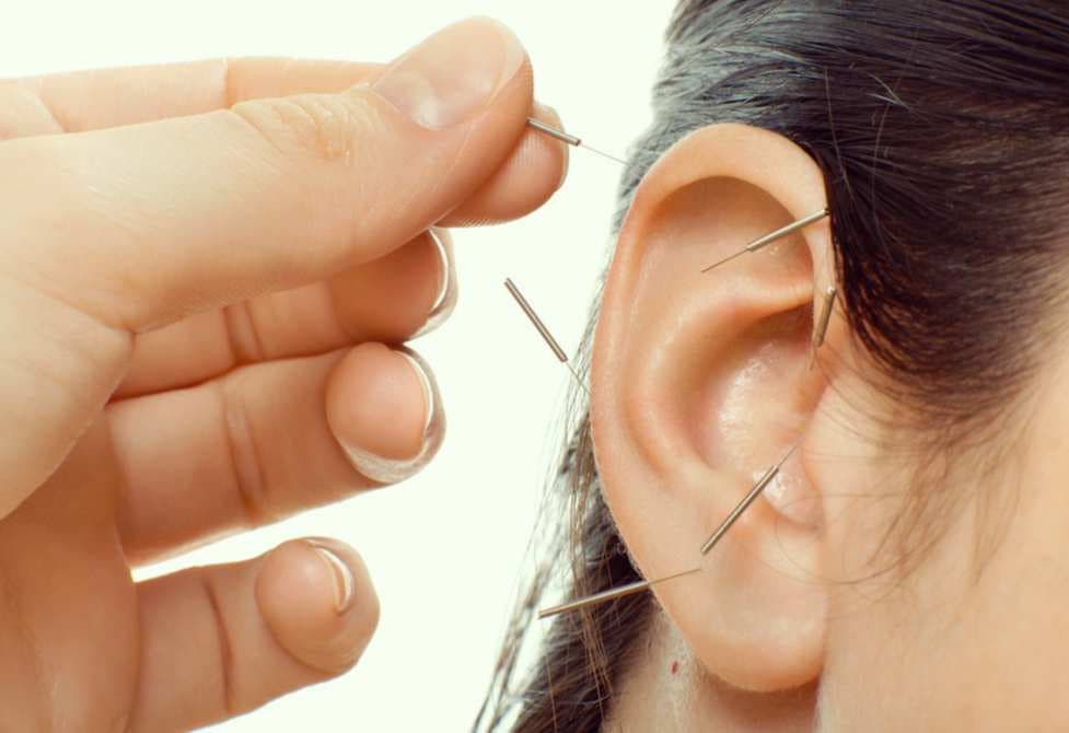 acupuntura auricular